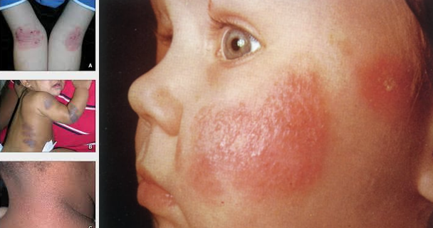 <ul><li><p><strong>Inflammatory Genetic immune disorder; also called eczema.</strong></p></li><li><p>Characterized by lichenification, extreme itching and inflamed, reddened, and swollen skin, scaly.</p></li><li><p><strong>Erythematous patches:</strong></p><ul><li><p>Vesicles, crusts.</p></li><li><p>Pruritus.</p></li></ul></li><li><p><strong>Nursing Care:</strong></p><ul><li><p>Wet (moist) dressings for oozing.</p></li><li><p>Occlusive for moisture.</p></li><li><p>Assess environment (moisture, dust mites, and cat dander).</p></li><li><p><strong>Medications: </strong>Antihistamines, corticosteroids, antibiotics (treating secondary infection), immunomodulators (blunting their immune system so they aren’t as sensitive).</p></li></ul></li></ul><p></p>