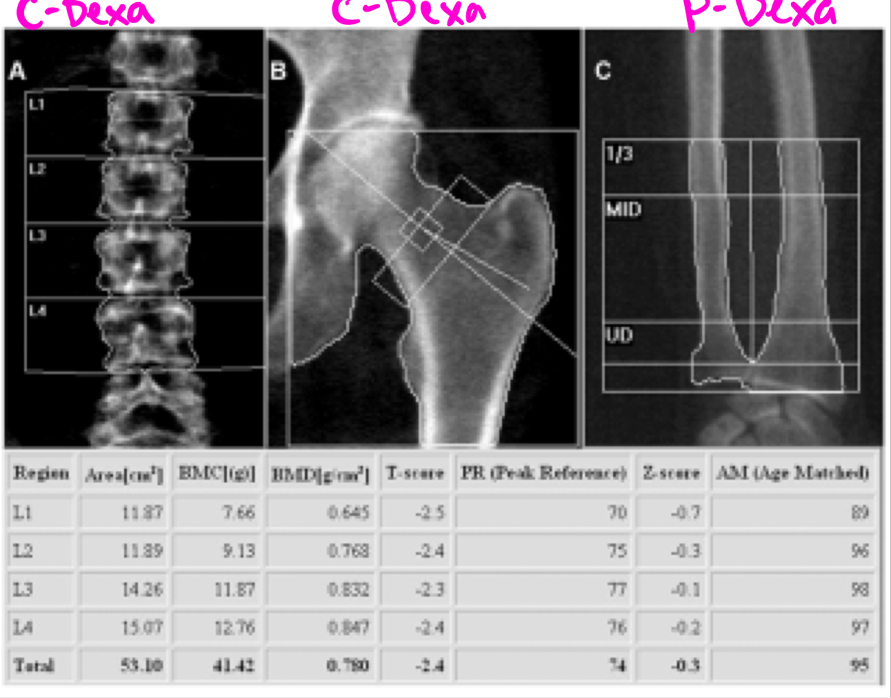 <p>Measurements of the lumbar spine demonstrate a total T-score in the range of osteopenia</p>