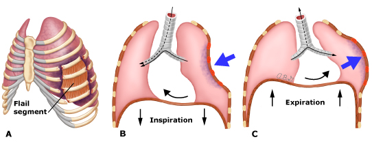 <p>multiple rib fractures→paradoxical movements of thorax/chest</p><p>inspiration→depression of injured area</p><p>expiration→injured area bulges outward</p>