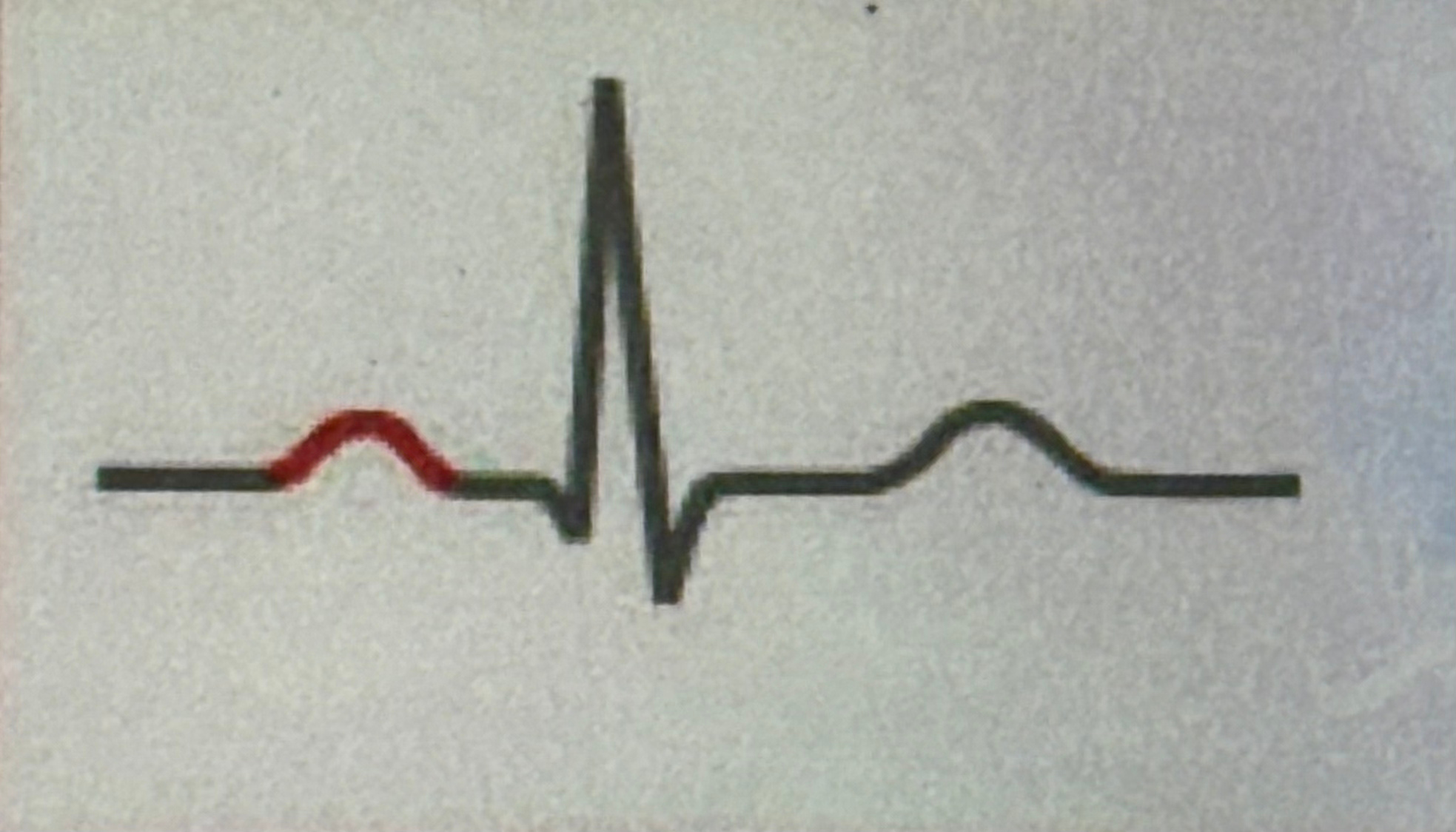 <p>atrial depolarization (atrial contracts blood to the ventrical</p>
