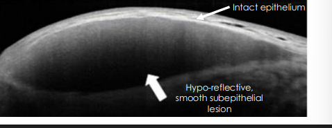 <p>OCT (high resoln)</p><ul><li><p>hyporefelctive/dark</p></li><li><p>smoooth subepithelial lesion</p></li></ul><p></p>