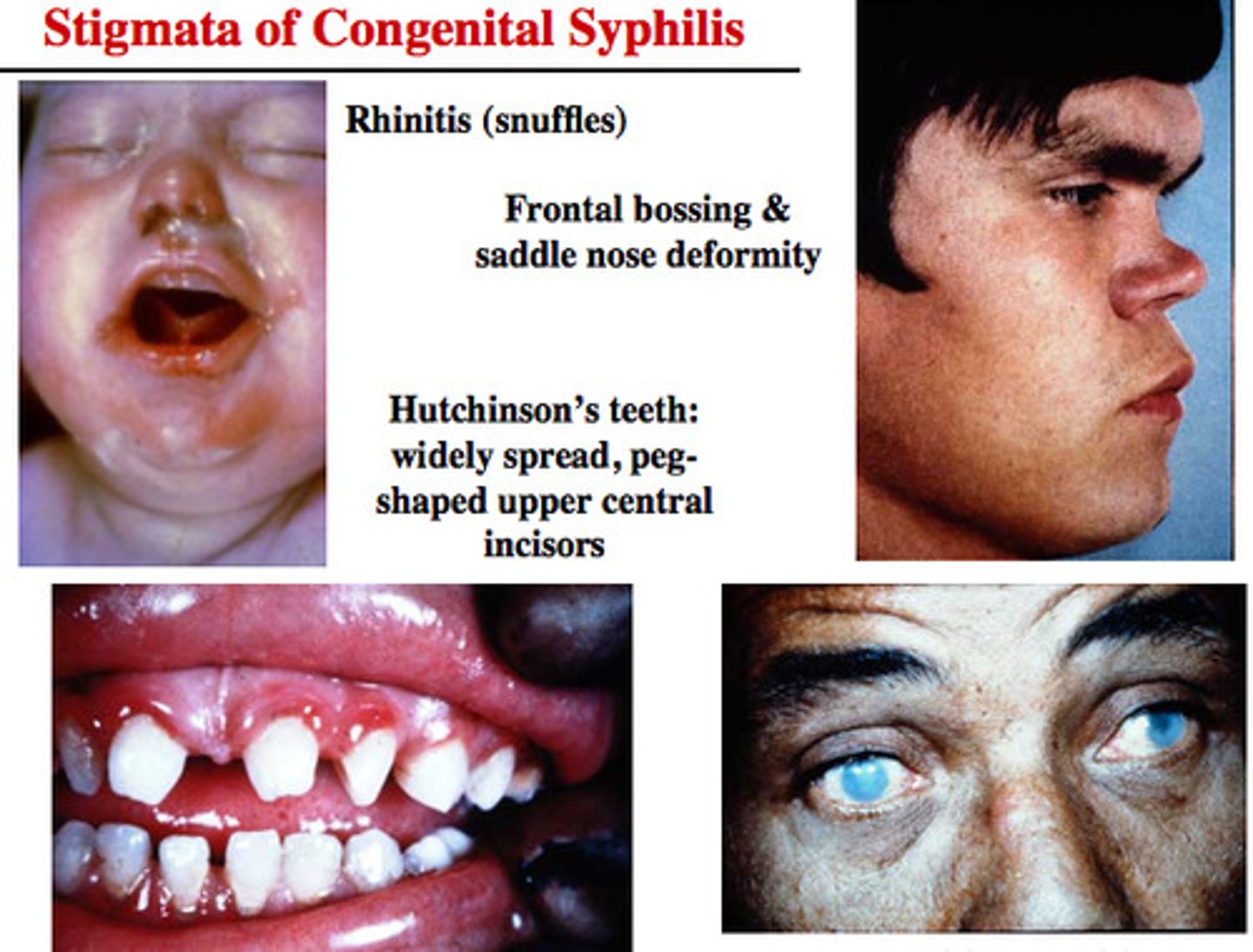 <p>S+S: Failure to gain weight, loss of hearing, loss of vision, skeletal abnormalities, scarring of the skin around the genitals, teeth abnormalities</p><p>Transmission: Mother to baby via placenta</p>