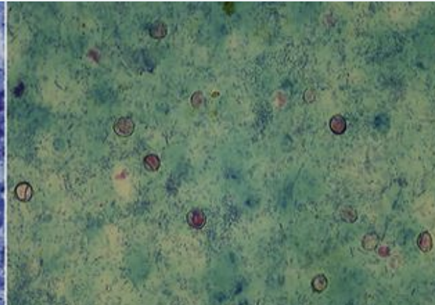 <p>Which stain, also called Ziel-Neelsen, is used to diagnose Cryptosporidium in fecal smears? They stain the oocysts present, which are approximately 5 um in diameter and appear red-pink.</p>