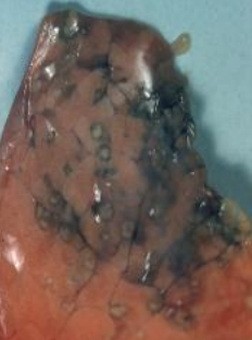 <p>Why is there necrosis due to acute aspergillosis?</p>