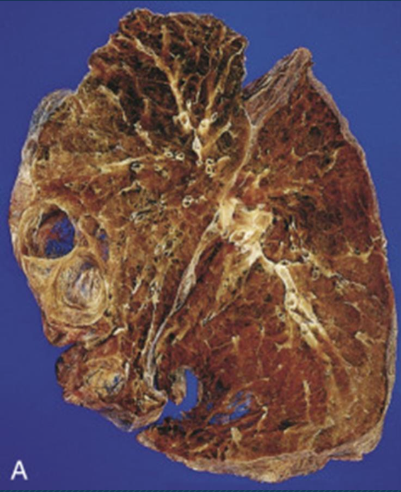 <p>Tipo de enfisema</p>