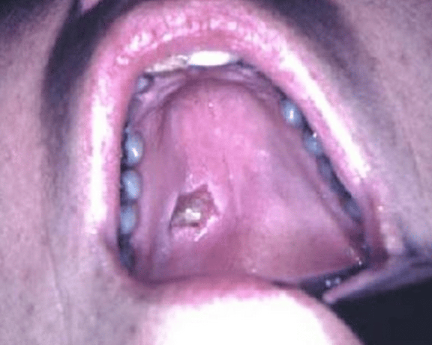 <p>results from ischemia and infarction of minor salivary glands and typically involves the palate.</p>
