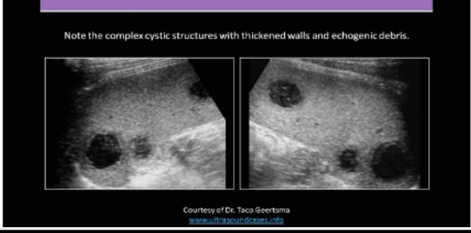 <p>What does the following describe?</p><p>•It is rare. May be associated with endocarditis, septicemia and trauma</p><p style="text-align: start">•May see them status post splenectomy</p><p style="text-align: start">•Symptoms include pain, dizziness, faintness,</p><p style="text-align: start">•<em>Lab Testing: </em>decreased hematocrit, fever, increased WBC and possible septicemia</p>