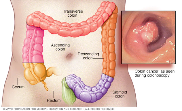 <ul><li><p><span>cancer of the colon or rectum, may begin as noncancerous polyp</span></p></li><li><p><span>Symptoms: blood in stool, abdominal pain, constipation, anemia, fatigue</span></p></li></ul>