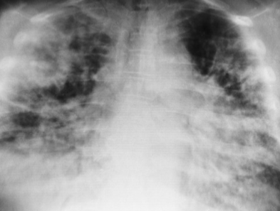 <p>Interstitial pneumonia</p>