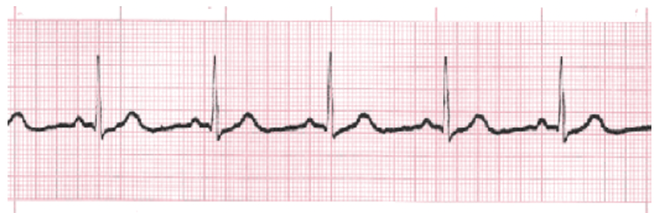 <p>What is the rhythm?</p>