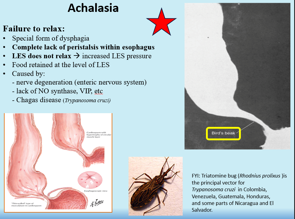 <p>Failure of LES to relax (constantly contracted)</p><ul><li><p>Food is retained in esophagus and in LES</p></li></ul><p>Complete lack of peristalsis within esophagus!</p><p></p>