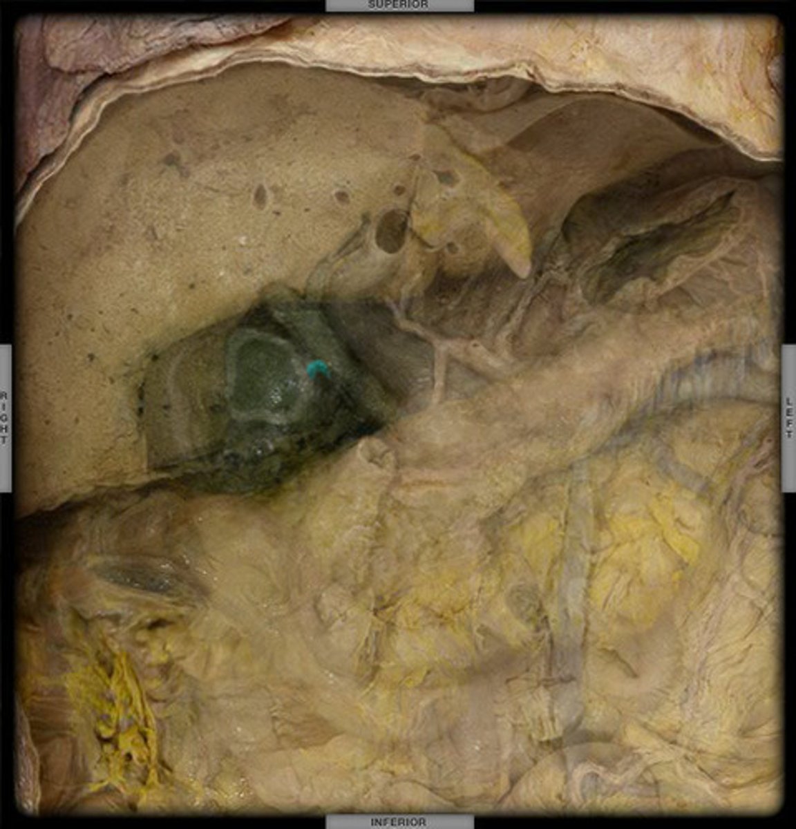 <p>a duct draining bile from the gallbladder; merges with the common hepatic duct to form the common bile duct</p>