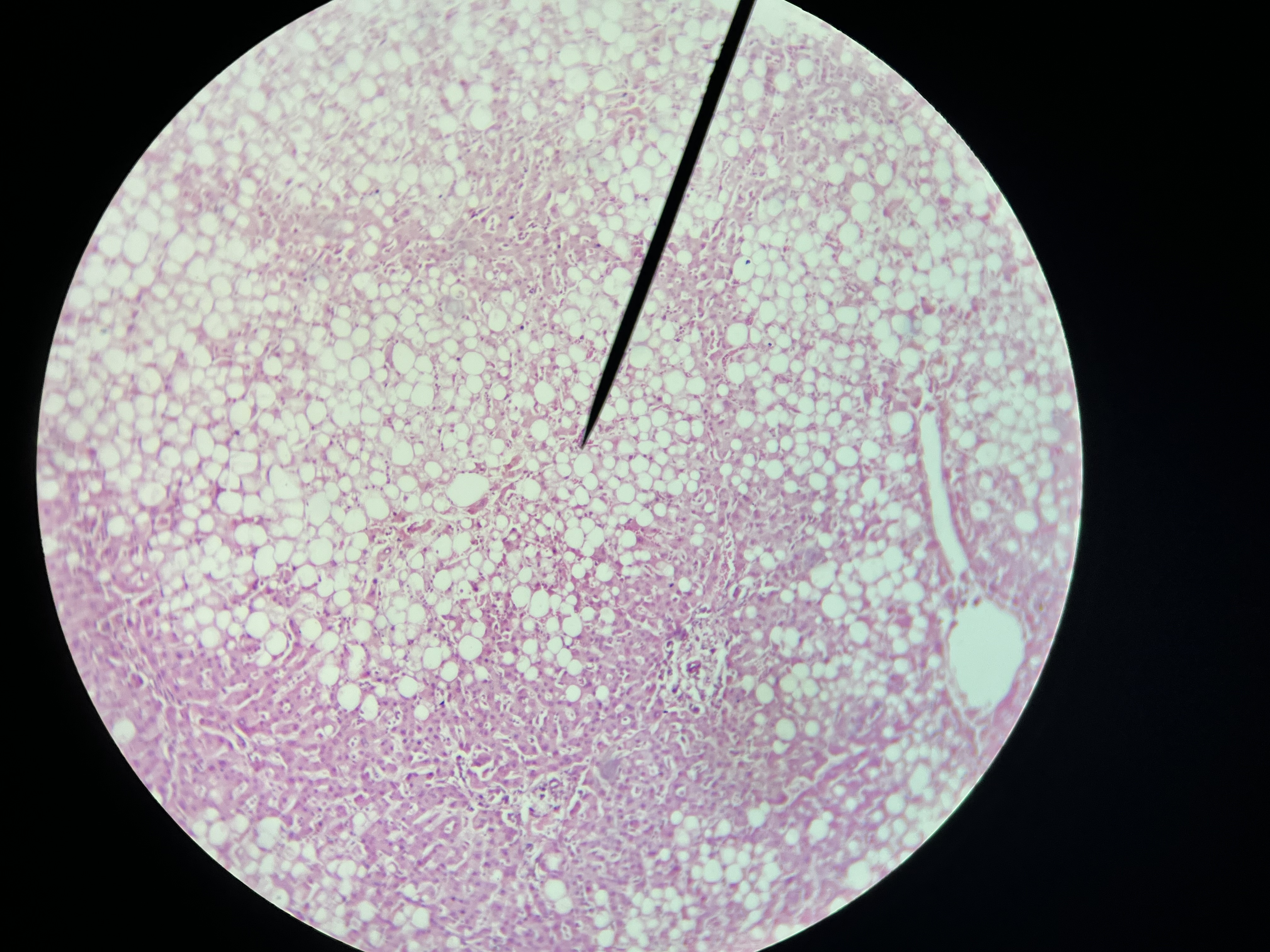 <p>A reversible condition where excess fat accumulates in liver cells, often associated with alcohol consumption or metabolic disorders. </p>