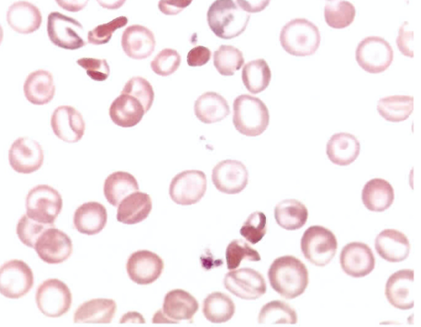 <p>C. Hemoglobin SC disease</p>