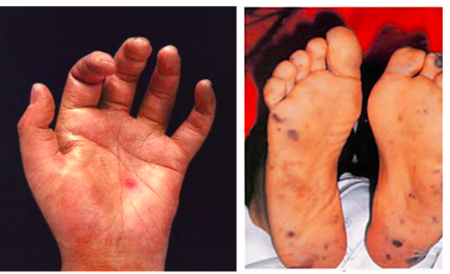 <p>sign of acute, bacterial endocarditis</p>