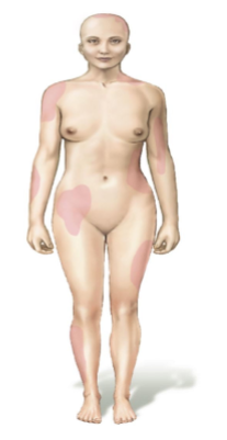 <p>Depiction of the absence of sweat glands in the shaded regions in a female due to them being Heterozygous for the X-linked condition</p><p>The locations vary from female to female, based on the random pattern of X chromosome inactivation during early development, resulting in unique mosaic distributions of sweat glands in heterozygotes.</p>