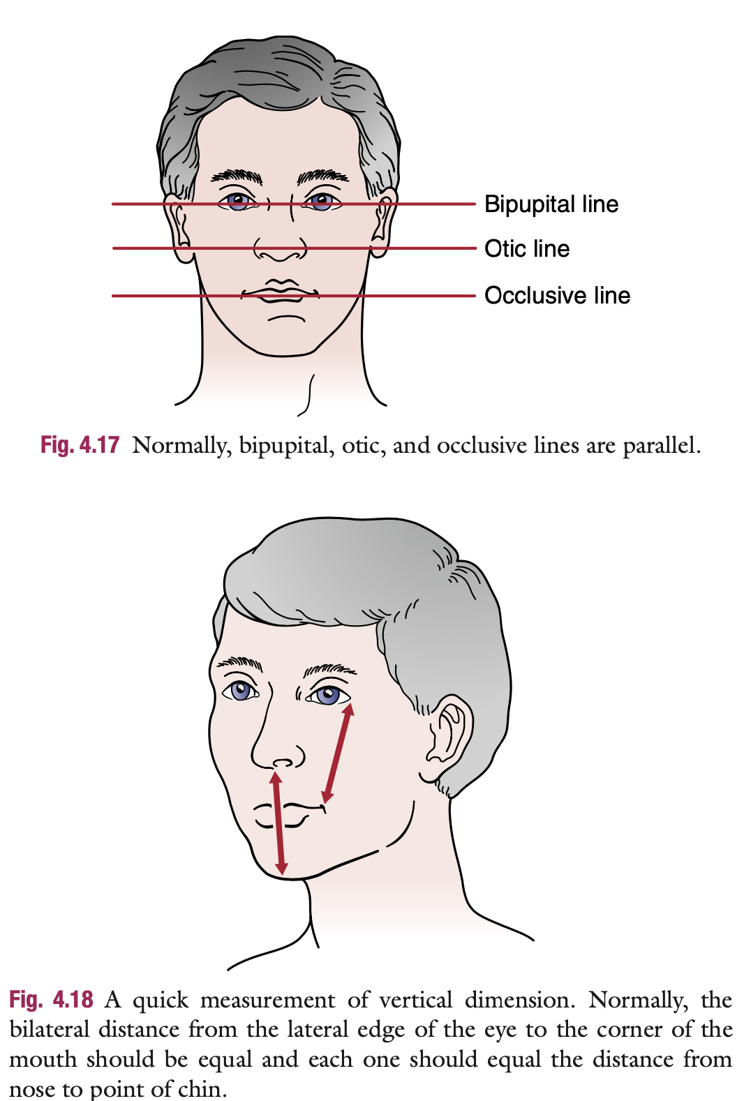 <ul><li><p> The horizontal bipupital, otic, and occlusive lines should be parallel to each other</p><ul><li><p>Loss of teeth on one side can lead to convergence in which at least two of the lines may converge because the jawline is short on one side relative to the other.</p></li></ul></li><li><p>Measure the vertical dimension (quick way; equal measurements dapat)</p><ul><li><p>lateral edge of the eye to the corner of the mouth</p></li><li><p>from the nose to the chin</p><ul><li><p>If the 2nd measurement is smaller than the first by<strong> 1 mm or more</strong>, there has been a loss of <strong>vertical dimension</strong> →  loss of teeth, overbite, or TMJ dysfunction.</p></li></ul></li></ul></li></ul><p></p>