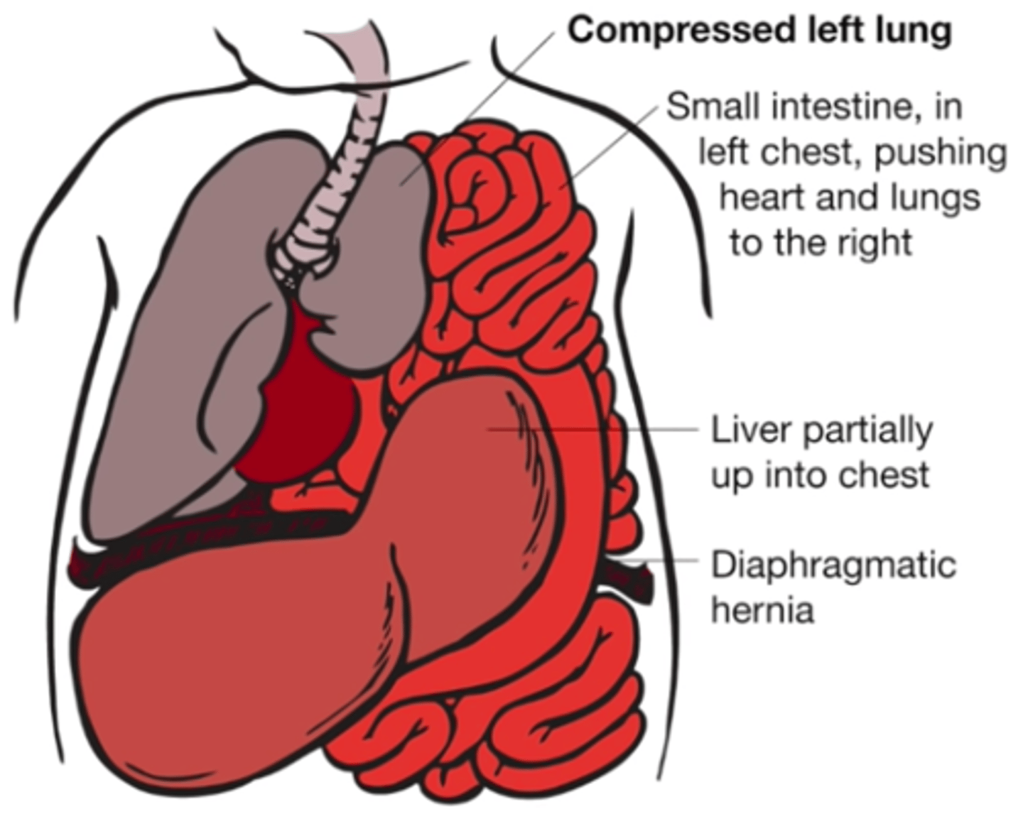 <p>Failure of diaphragmatic tissue to close resulting in the abdominal contents to herniate into the thoracic cavity; respiratory insufficiency (herniated intestines interfere w/ lung development)</p>