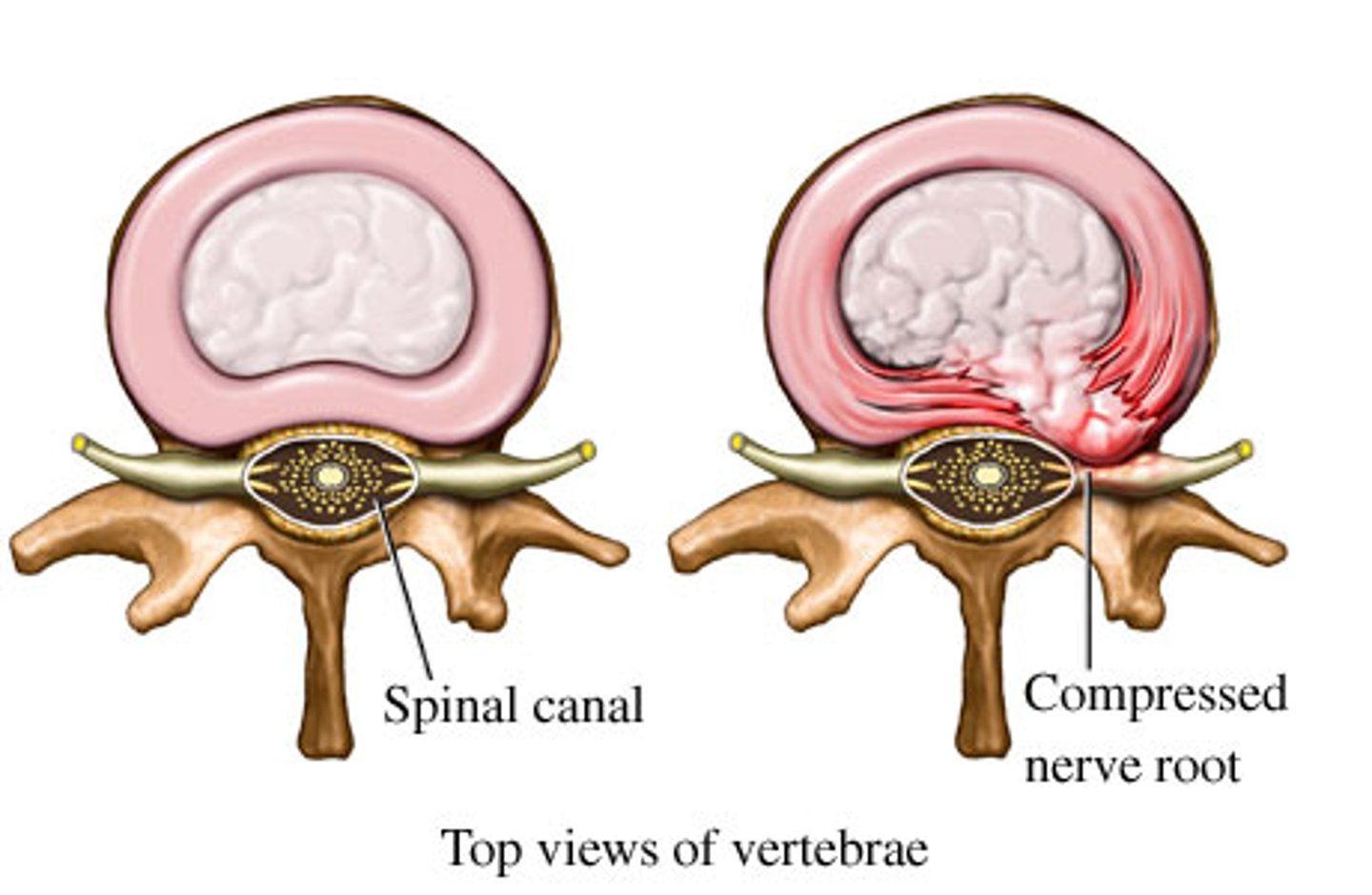 <p>rupture of the outer layer of a disk that puts pressure on spinal nerves</p>