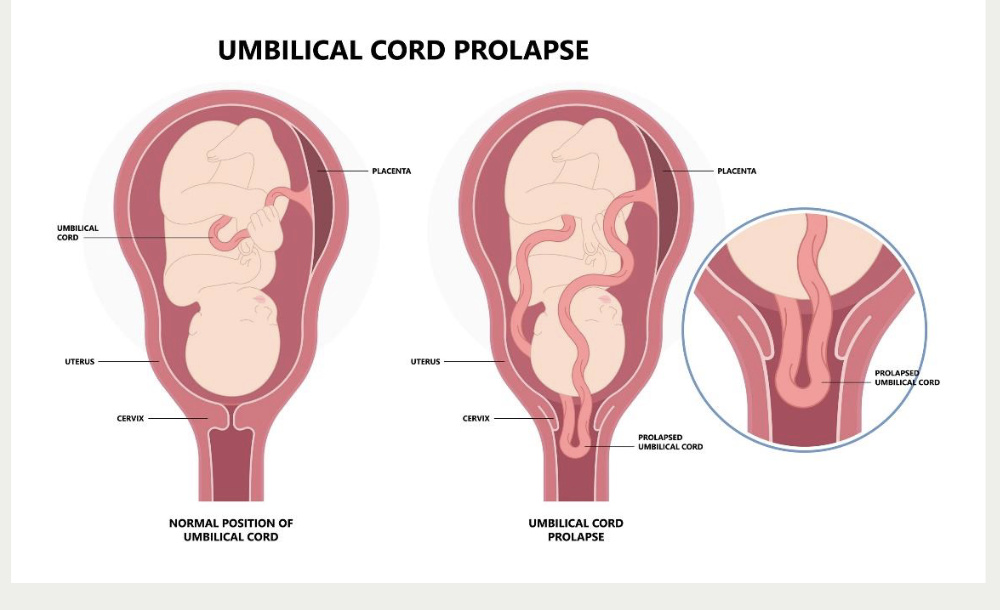 <p>A <strong>prolapsed umbilical cord</strong> occurs when the <strong>umbilical cord slips down through the cervix into the vagina <em>ahead of or alongside the presenting part of the fetus</em></strong>, <strong>before or during labor</strong>, which can compress the cord and <strong>reduce or cut off blood flow and oxygen to the baby</strong>.</p><p></p><p><strong>signs and symptoms</strong></p><ul><li><p>long umbilical cord</p></li><li><p>malpresentation</p></li><li><p>non-engaged fetus</p></li><li><p>polyhdramnios</p></li><li><p>preterm labor</p></li></ul><p></p><p>typicall happens wiht ROM; large gush —&gt; expelled cord</p><p></p>