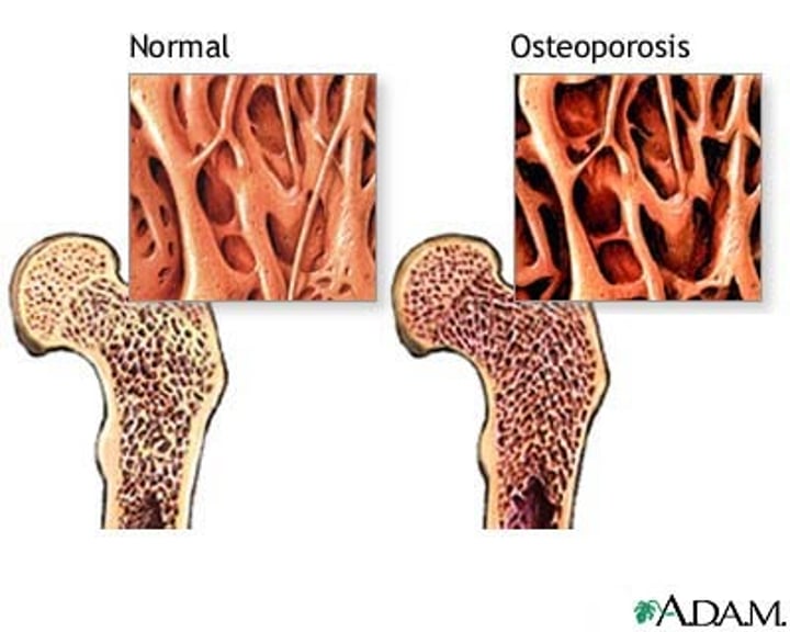 <p>loss of bone density</p>