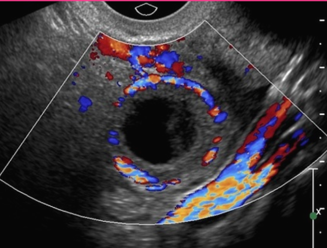 <p>Corpus luteum cysts are commonly seen up to _____ weeks of pregnancy </p>