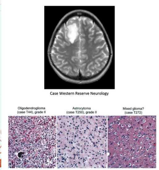 <p>Diseases of the oligodendrocytes </p>