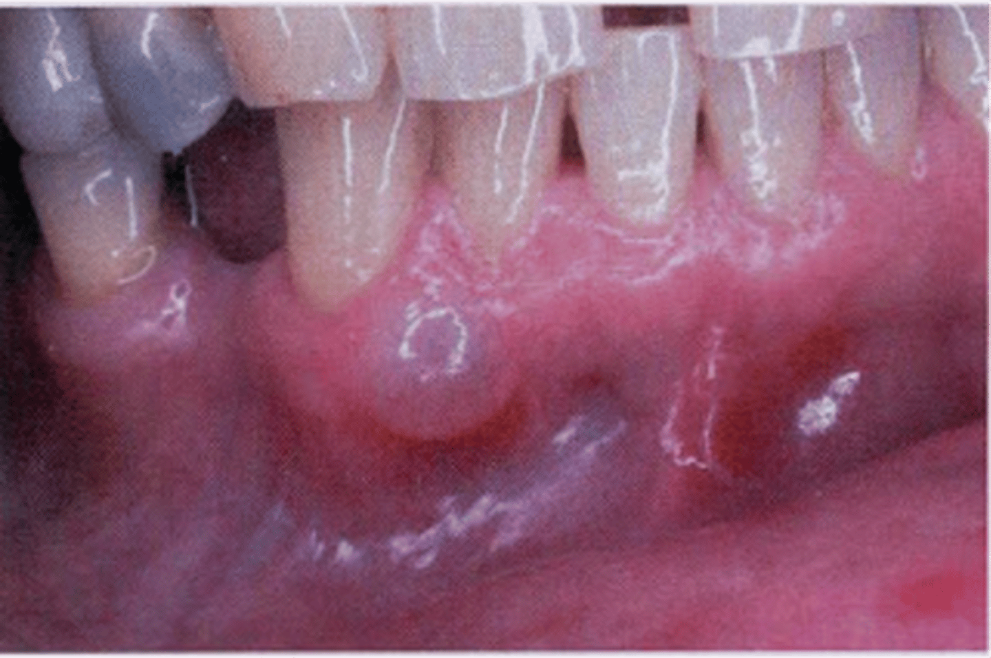 <p>gingival cyst of the adult</p>