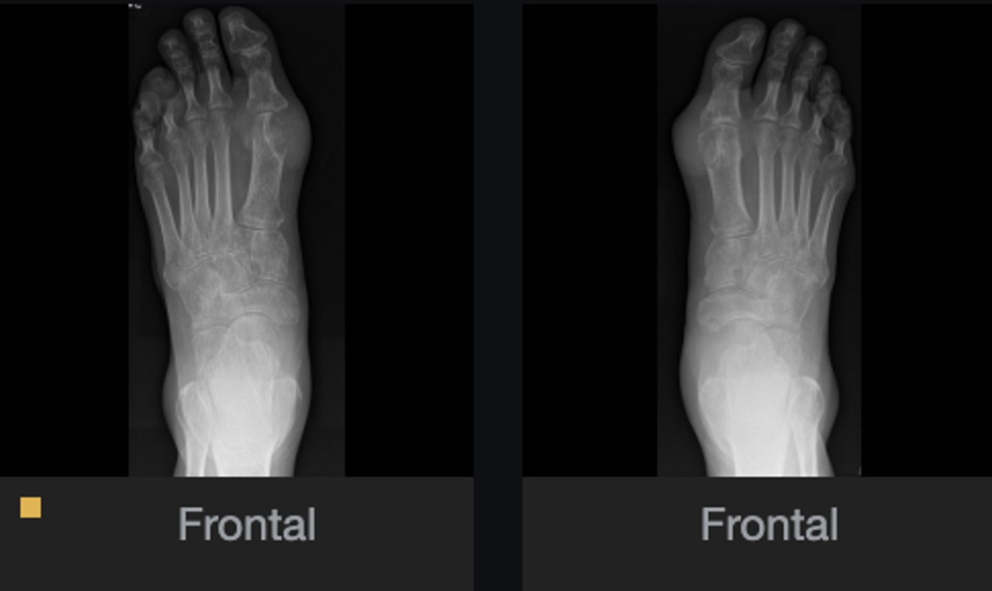 <p>What abnormal findings are present on the foot series?</p>