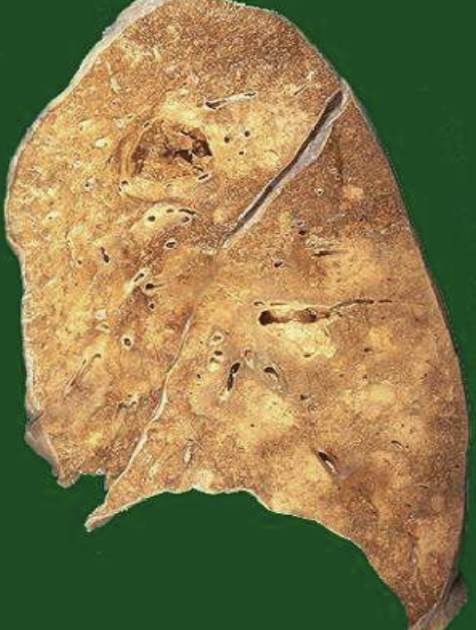<p>Enzymatic digestion converting tissue to liquid viscous mass; classic in brain infarcts and abscesses. Soft, gel-like</p>