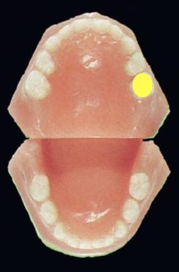 <p>What is this tooth (HADERUP)?</p>