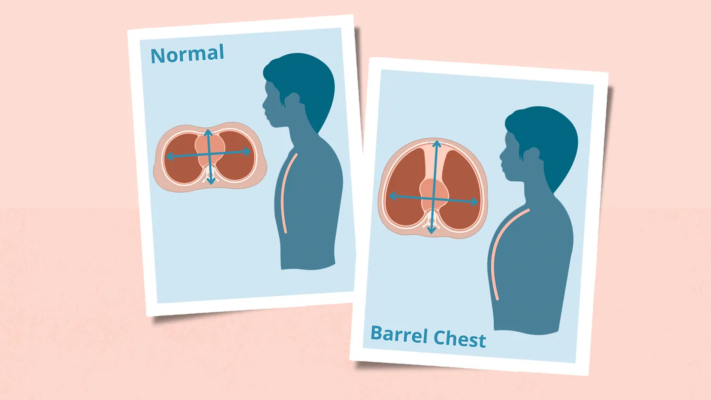 <p>increased AP diameter</p><p>normal: infancy<br>aging</p><p>DX: COPD</p>