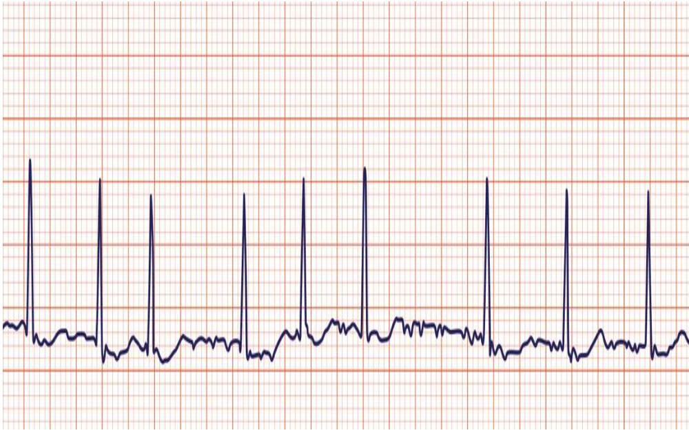 <p>Decreases Cardiac Output </p><p>Irregular rhythm no visbile P waves narrow QRS risk for thromboembolism </p><p>Usually wide but doenst have to be </p>