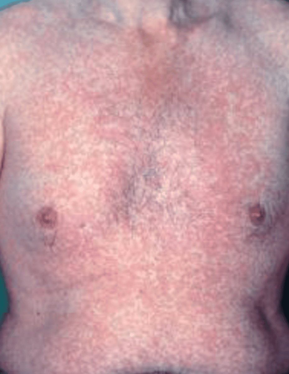 <p>What type of drug reaction is this?</p>