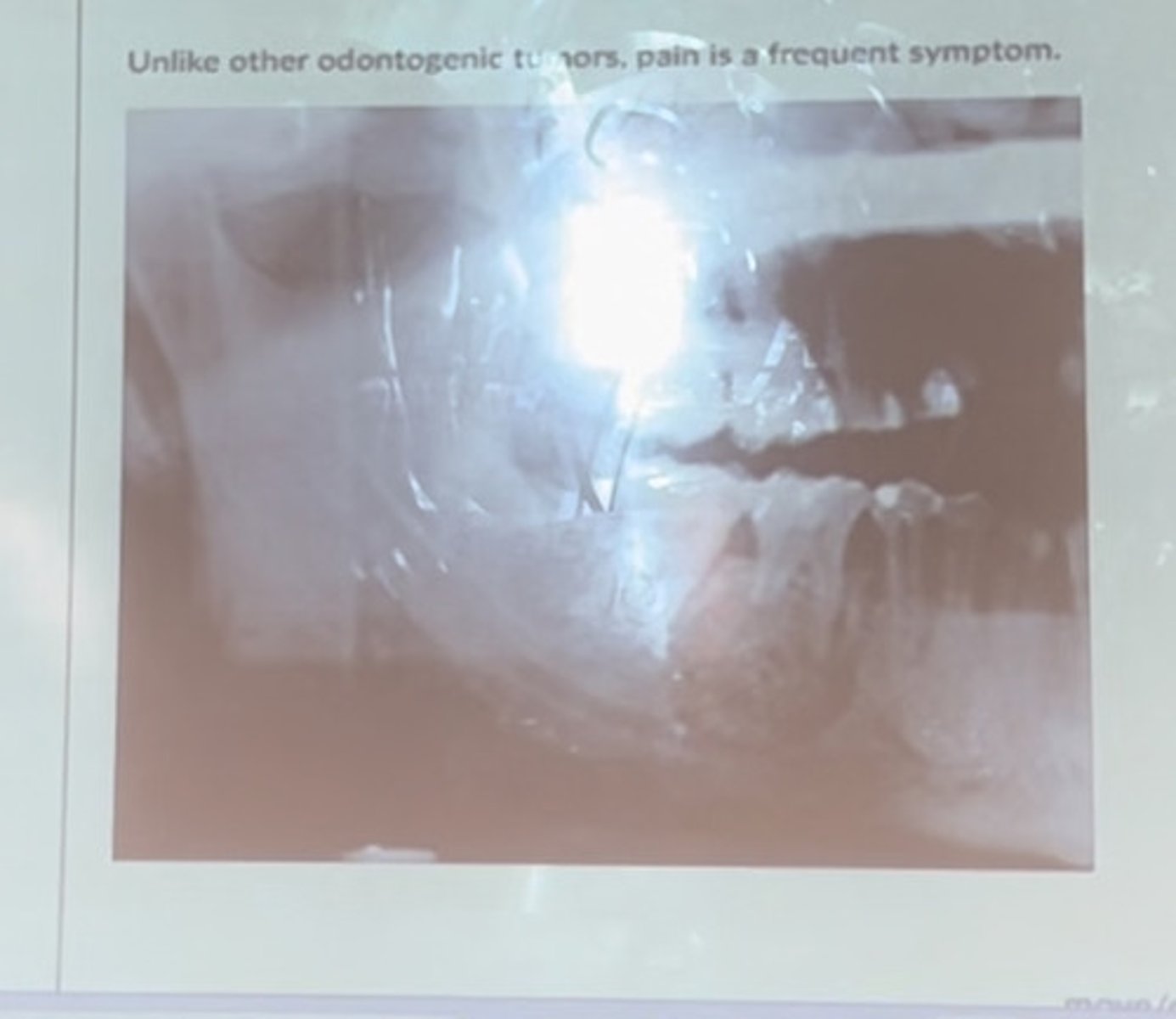 <p>Unlike other odontogenic tumors, pain is a frequent symptom</p>