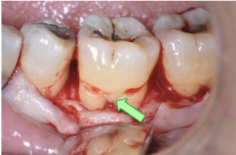 <p>Enamel projections may be removed because connective tissue attachment is not possible on enamel, and the projections may created a pathway for the ingress of bacteria that will have detrimental effect on periodontal health</p>