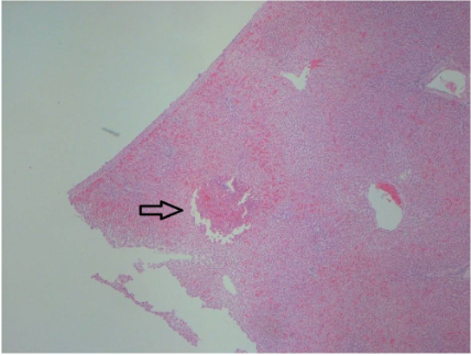 <p>What is the most evident microtomy artifact demonstrated by the arrow in this image?</p><p>Water bath bubble under the section</p><p>Parched earth</p><p>Debris</p><p>Venetian blinds/washboarding</p>