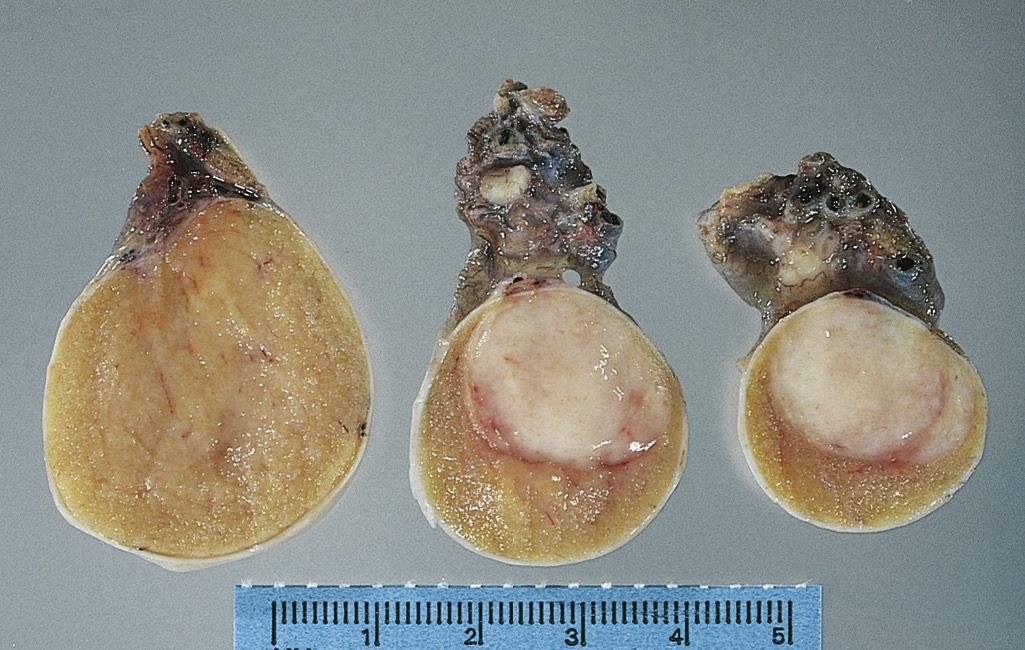  A 29-year-old man complains of a vague feeling of painless heaviness in the scrotum for the past 5 months. He is otherwise healthy. Physical examination shows that the right testis is slightly larger than the left testis. An ultrasound scan shows a solid, circumscribed, 1.5-cm mass in the body of the right testis. The representative gross appearance of the mass is shown in the figure. A biopsy is done, and microscopic examination of the mass shows uniform nests of cells with distinct cell borders, glycogen-rich cytoplasm, and round nuclei with prominent nucleoli. There are aggregates of lymphocytes between these nests of cells. Which of the following features is most characteristic of this lesion?

 