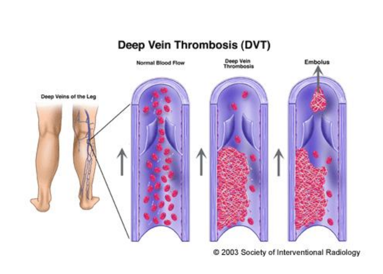 <ul><li><p>Moeilijk te achterhalen: 2/3 van de patiënten symptoomvrij</p></li><li><p>50% van patiënten met compatibele symptomen blijkt geen DVT te hebben</p></li><li><p>Post-mortem: 62% van ouderen doorliep een DVT</p></li></ul><p></p>