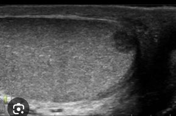 <p>SA: solid/homogeneous, hypoechoic masses with a smooth border</p><p>*The most common germ cell tumor</p>