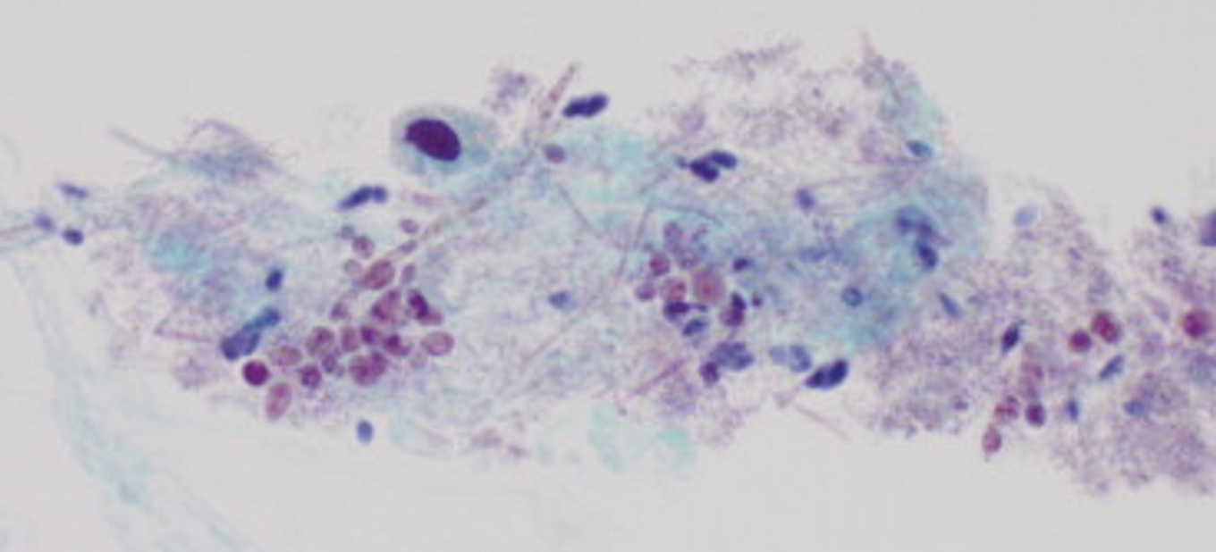 <p>What bug is shown in this cytology sample?</p>