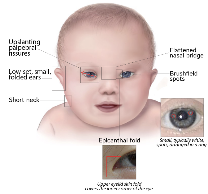 <p>The following characteristics are seen in what condition?</p><ul><li><p>heart defects</p></li><li><p>intellectual disability</p></li><li><p>up slanting palpebral fissures</p></li><li><p>flattened nasal bridge</p></li><li><p>brush field spots</p></li><li><p>epicanthal fold</p></li><li><p>increased risk of leukemia</p></li></ul><p></p>