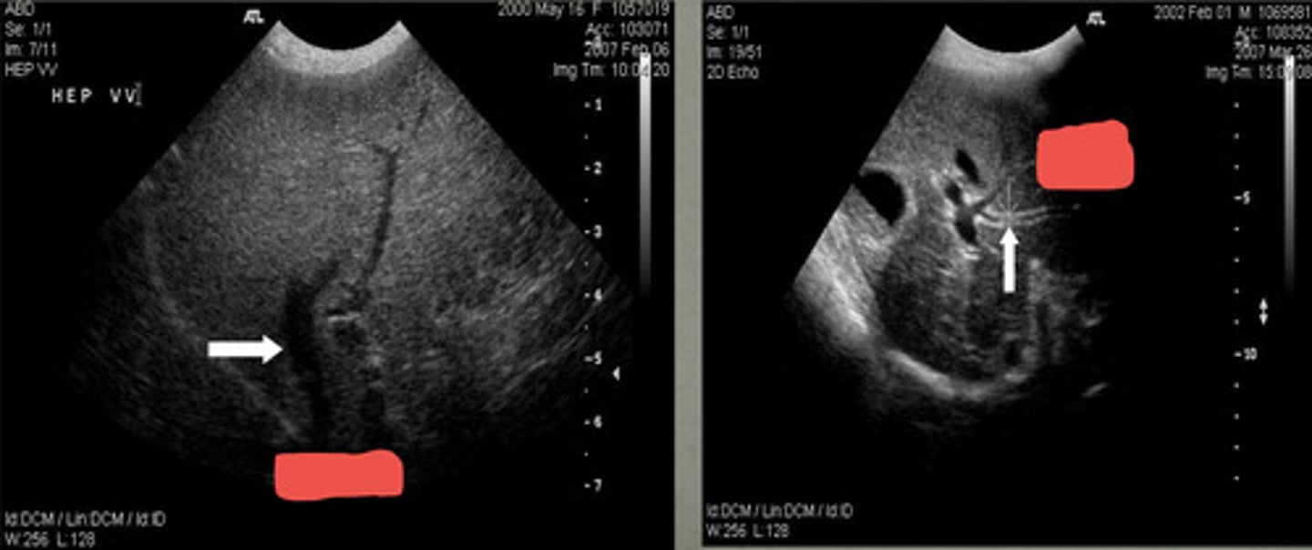 <p>which US shows the portal vein and which is hepatic vein?</p>