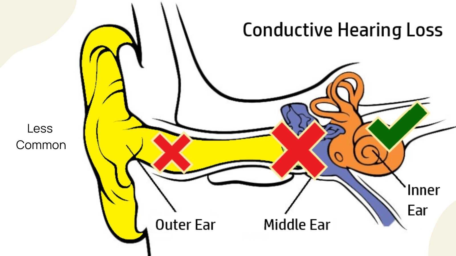 <p>a type of hearing loss caused by problems with the outer or middle ear that precent sound from reaching the inner ear</p>