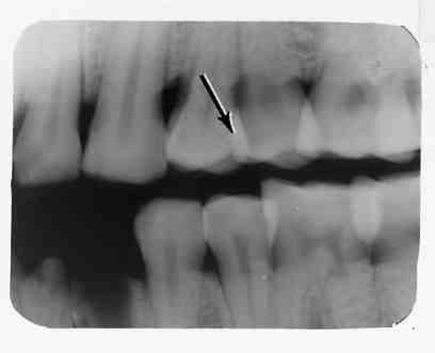 <p>The area where the contact area of one tooth is superimposed over the contact area of an adjacent tooth.</p>
