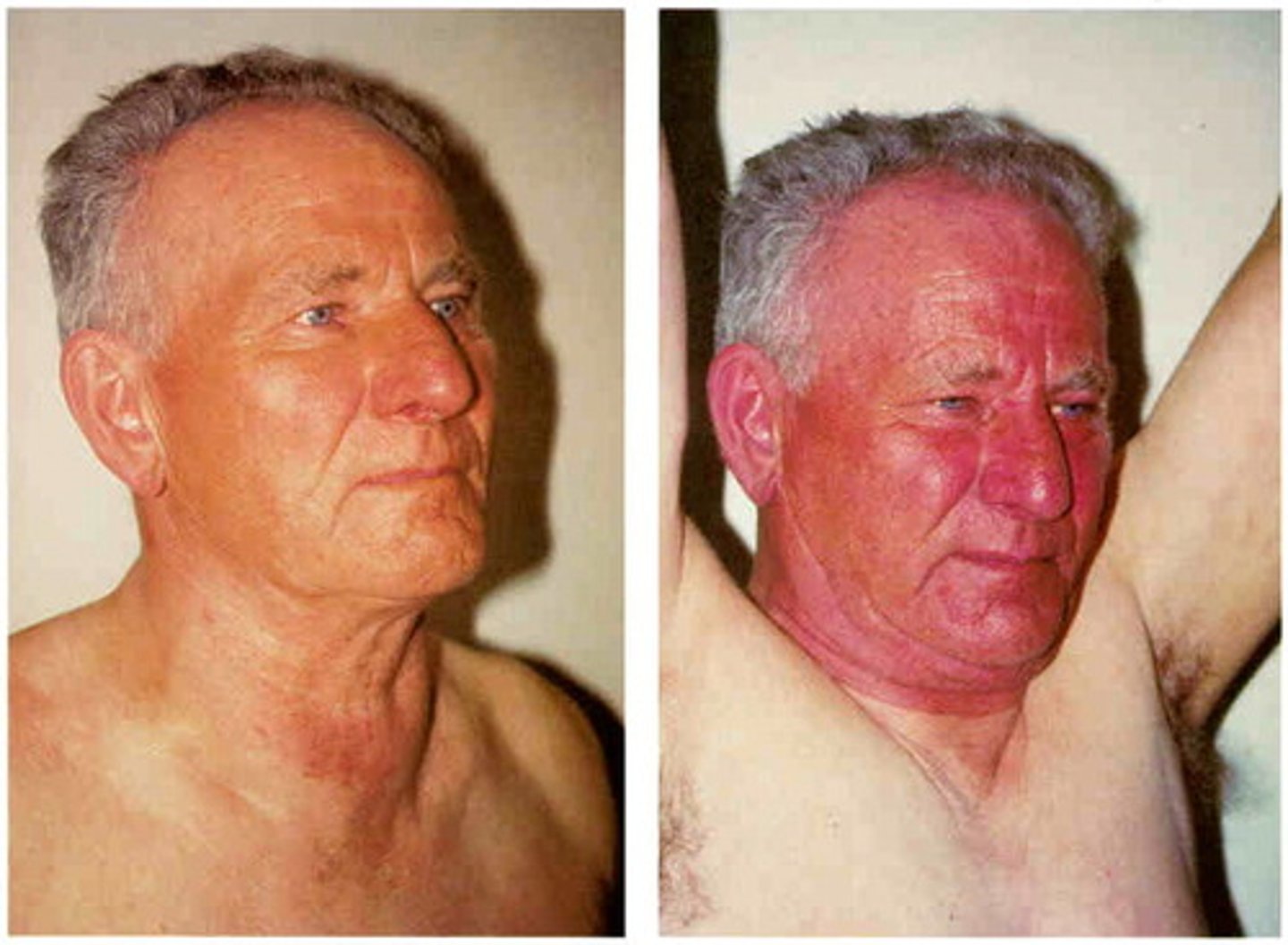 <p>headache</p><p>hot flushed face</p><p>hypotension</p>