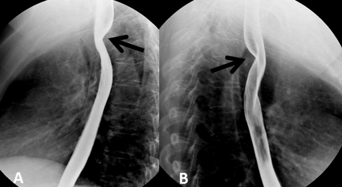 <p><span>1- Warning lights for x-ray on</span></p><p><span>2- Fluoro rooms should not be used as corridors. Where possible porters should not be knocking on the suite door when patients arrive. Sometimes you may need to lock the suite door for both radiation protection and privacy reasons.</span></p><p><span>3- Undercouch technique with II as close as possible to patient</span></p><p><span>4- Last image hold, scroll through previous run</span></p><p><span>5- Only those directly helping with procedure in room- when helping patient be aware of high dose areas around the unit.</span></p><p><span>6- Pb gowns, thyroid shields, glasses</span></p><p><span>7- Ceiling mounted glass screens, Pb skirts around II</span></p><p><span>8- Limiting screening times and the use of magnification</span></p><p><span>9- ID and pregnancy check</span></p><p></p>