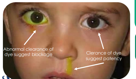 <p>fluorescein dye disappearance test </p><ol><li><p>yellow in eye = abnormal so blocked drain</p></li><li><p>yellow in snot  = clearance of dye if godo </p></li></ol><p></p>
