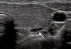 <p>A 50-year-old patient undergoes neck ultrasound for unrelated reasons. A small, flat, ovoid structure is seen posterior and adjacent to the thyroid, and is hypoechoic compared to the thyroid tissue. What does this finding most likely represent?</p>