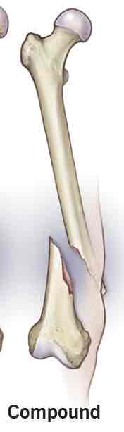 <p>Separate pieces are evident; “transverse fracture”</p><ul><li><p>bone can break through skin, extra damage to other tissues due to movement</p></li></ul>